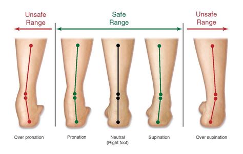 overpronation vs pronation.